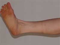 Yoga For Arthritis-(Internal Imbalances)