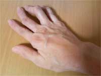 How Can Yoga Help in Rheumatoid Arthritis-II How Can Yoga Help in Rheumatoid Arthritis-II