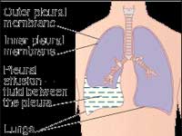 allergy,antibiotic,baby,chest infections,experimental allergy,infection,wheezing May Make Kids Wheeze