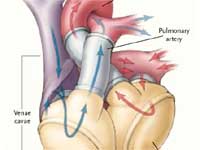 Artificial Heart Without ' Lub Hubs' Artificial Heart Without ' Lub Hubs'