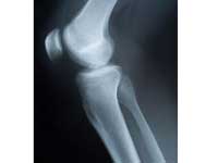 Interlocking Technology For Fractures Interlocking Technology For Fractures