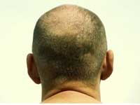 Baldness