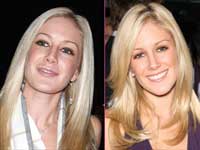 Heidi Montag before and after plastic surgery
