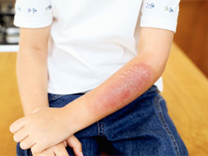 Tips To Heal Kids Of Diwali Burns Tips To Heal Kids Of Diwali Burns