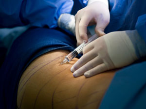 Liposuction, A Safe Weight Loss Surgery? Liposuction, A Safe Weight Loss Surgery?