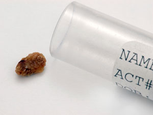 Dissolve Kidney Stones