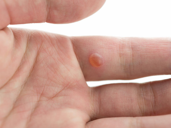 Home Remedies For Blisters From New Shoes Home Remedies For Blisters From New Shoes