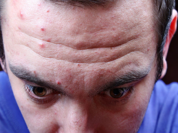 Natural Ways To Prevent Forehead Wrinkles Natural Ways To Prevent Forehead Wrinkles