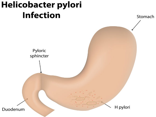 Can Drinking Too Much Alcohol Cause An Ulcer Can Drinking Too Much Alcohol Cause An Ulcer