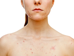 Effective Home Remedies For Chest Acne 