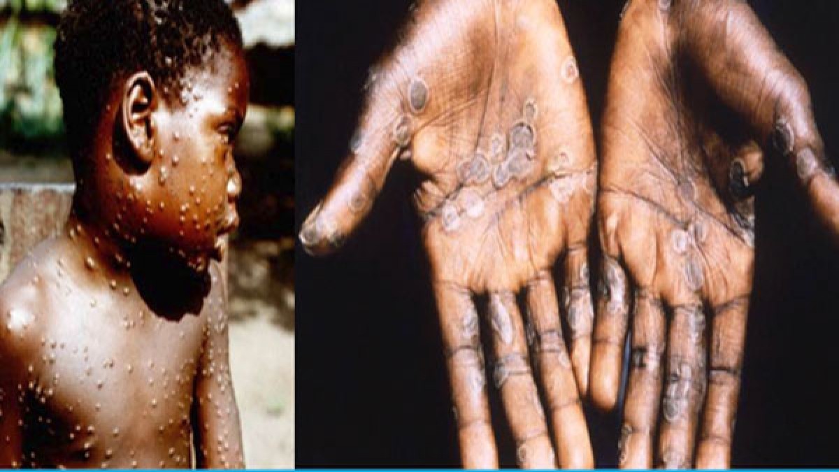 WHO Declares Monkeypox Outbreak A Public Health Emergency, Only These Vaccines Are Approved For The Treatment