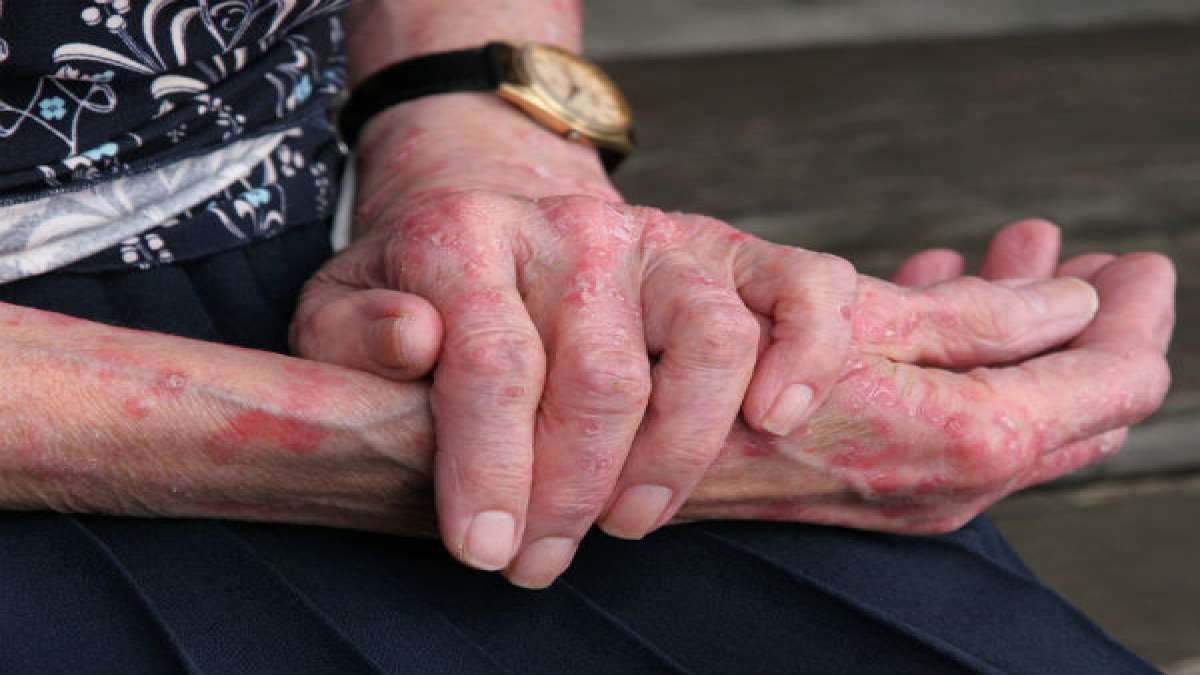 Peeling Fingertips Top 9 Care Tips