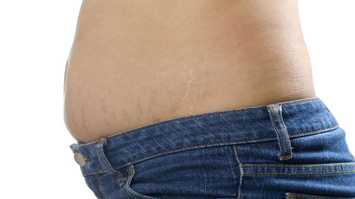 Hide Stretch Marks With Makeup