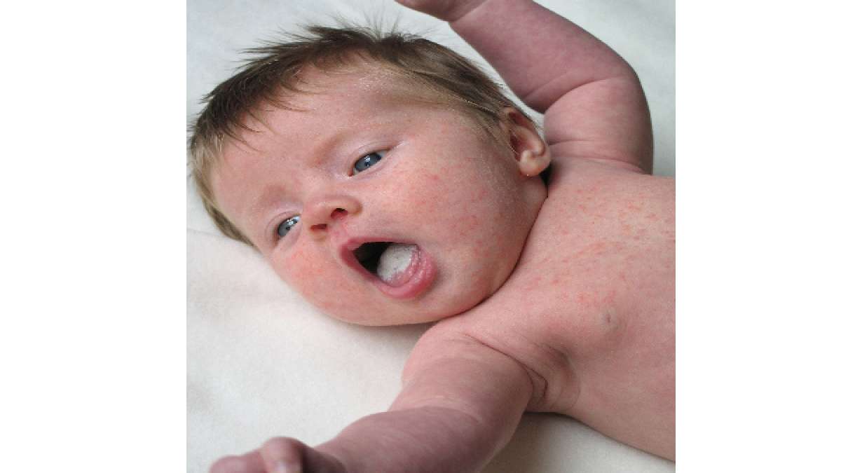 Causes And Treatment For Oral Thrush In Babies