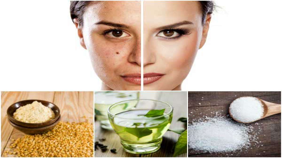 DIY Green Tea, Sugar And Flour Face Scrub To Reduce Acne Scars