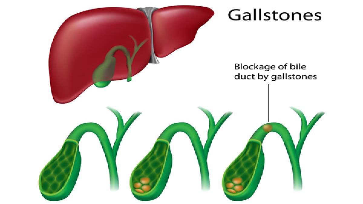Effective Ways To Treat Gallbladder Stone With Ayurveda