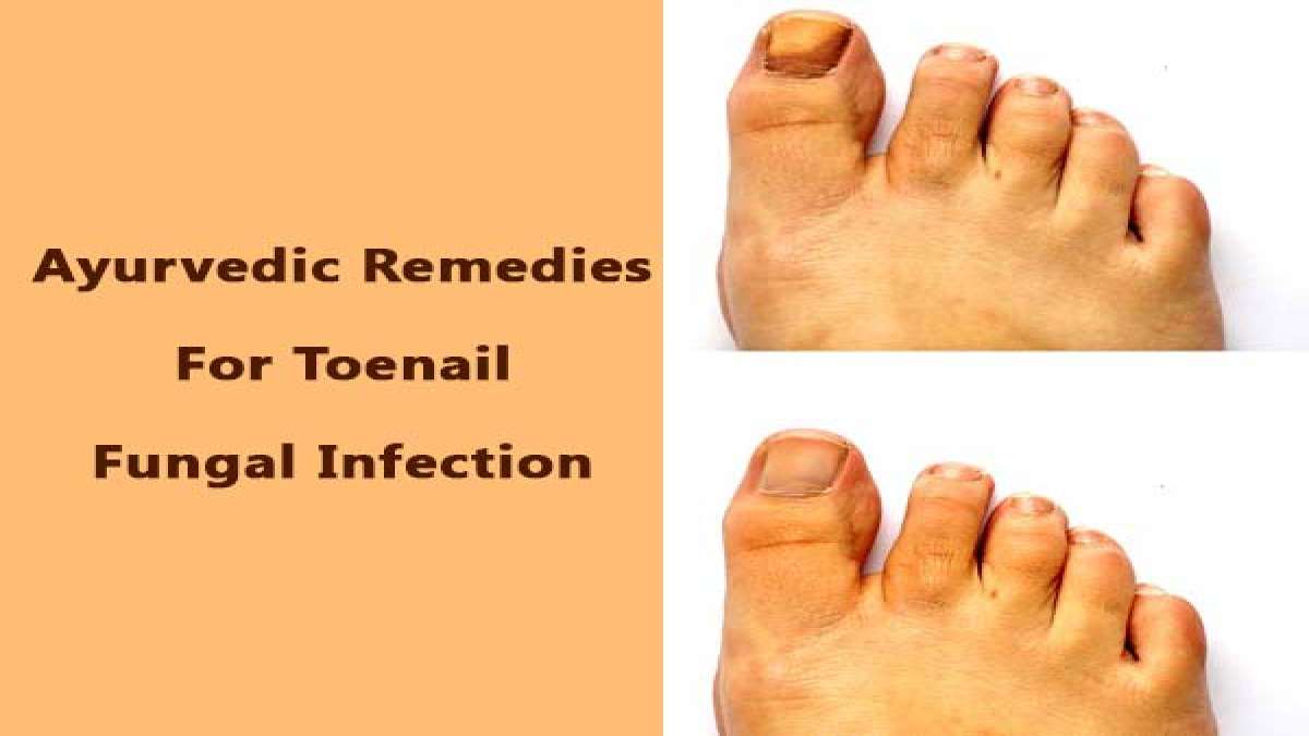 Quick Ayurvedic Remedies For Toenail Fungal Infection (Foot Care For