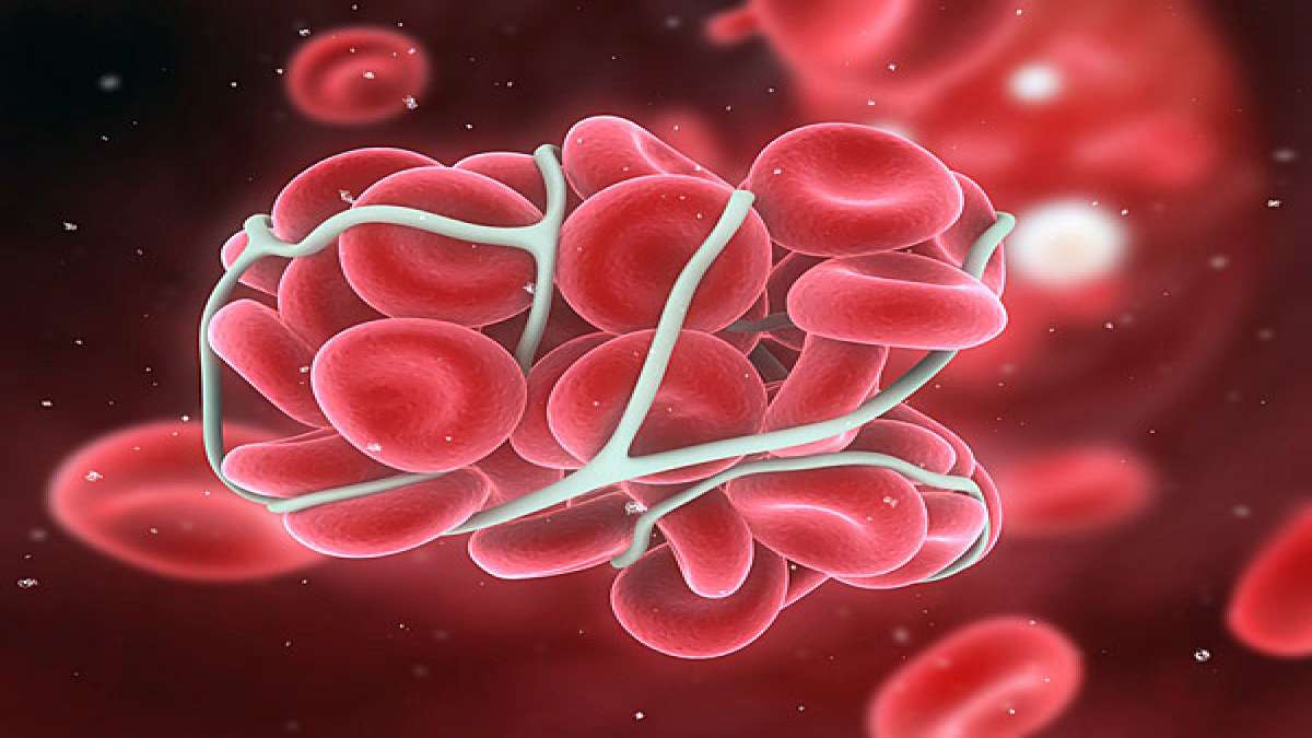 Fatal Effects Of Blood Clots You Need To Know!