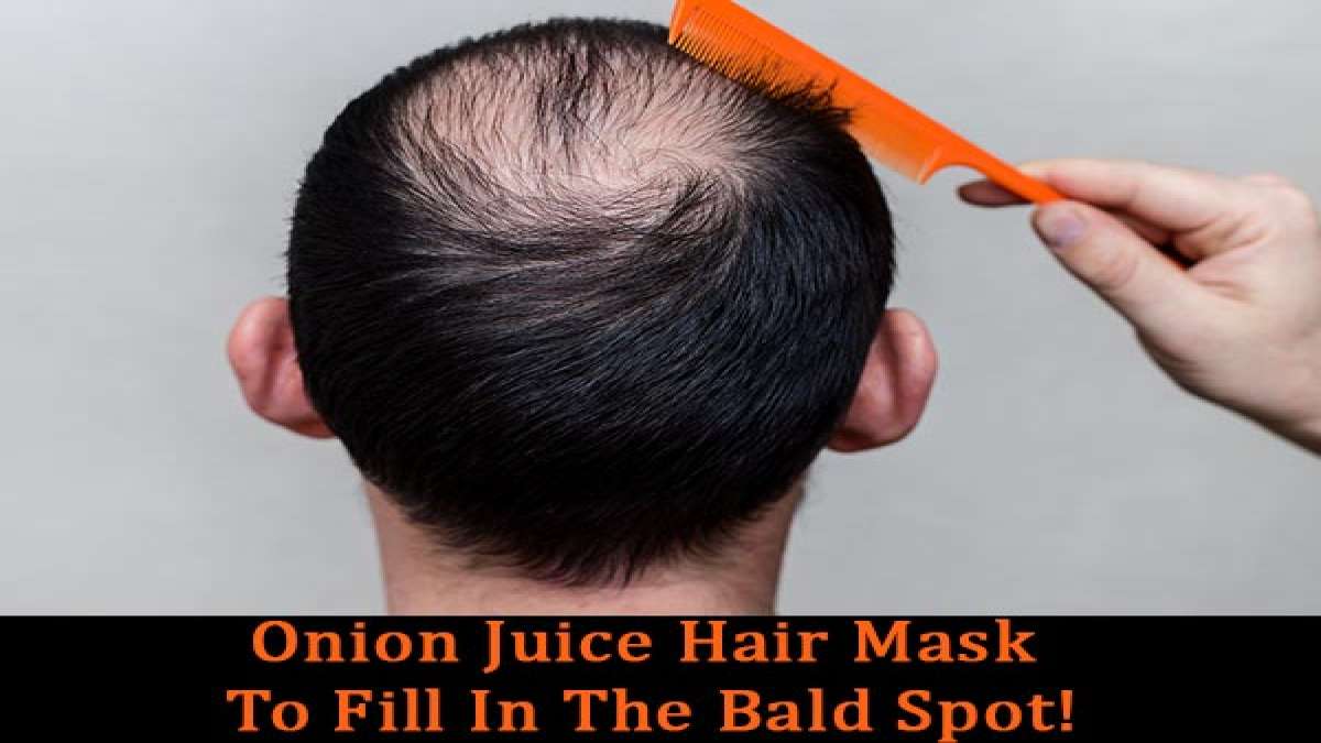 Onion Juice Hair Mask To Fill In The Bald Spot!