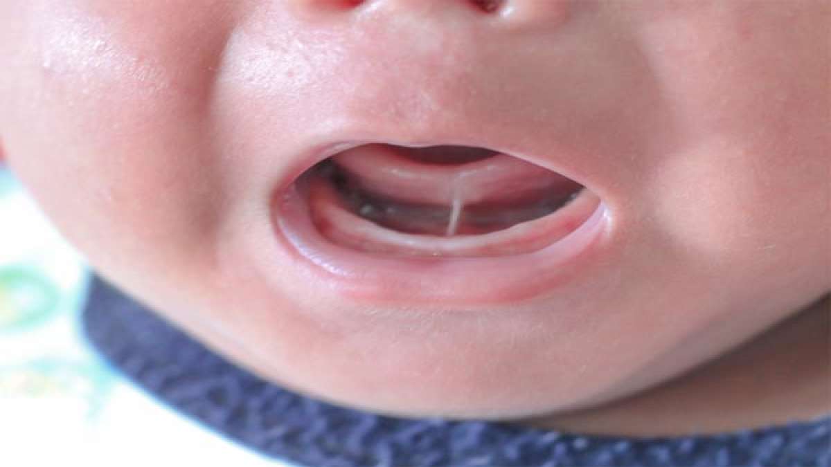 How Can Tongue Tie Affect Baby