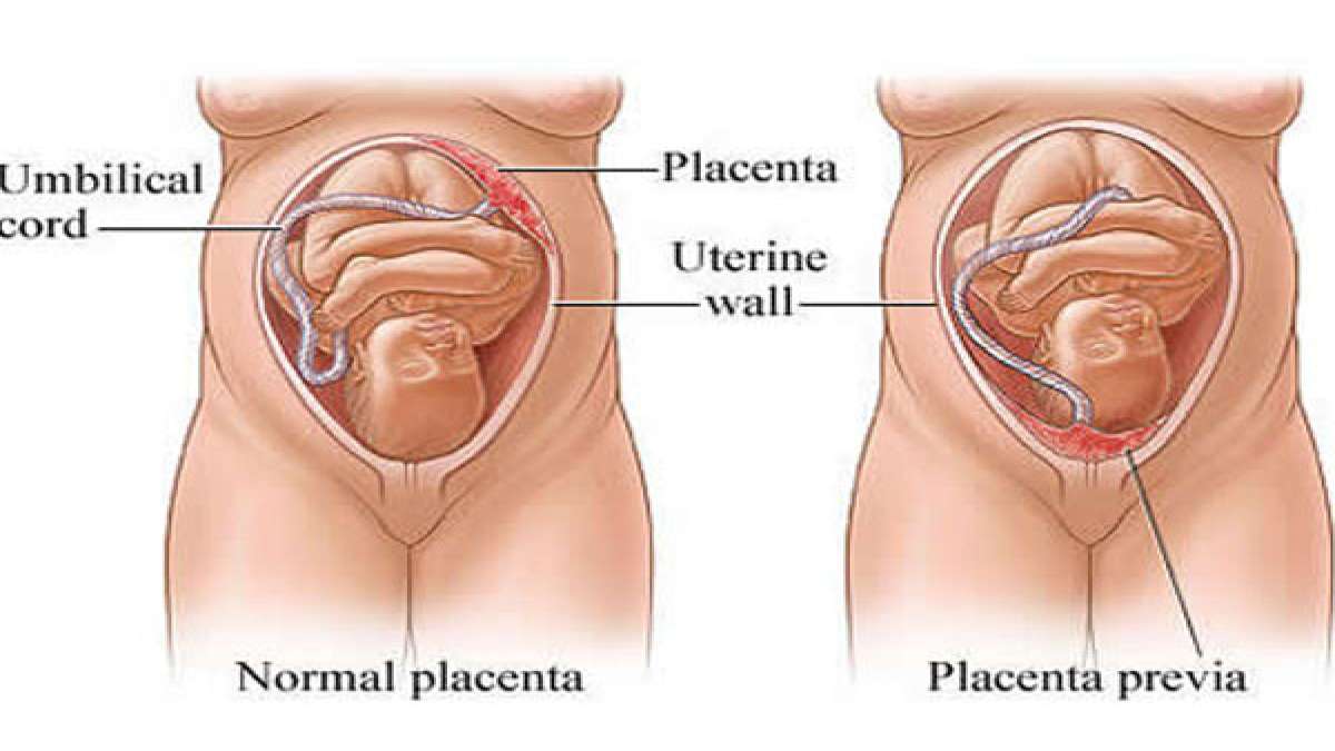 Low lying placenta (placenta previa) Causes, Symptoms and treatment