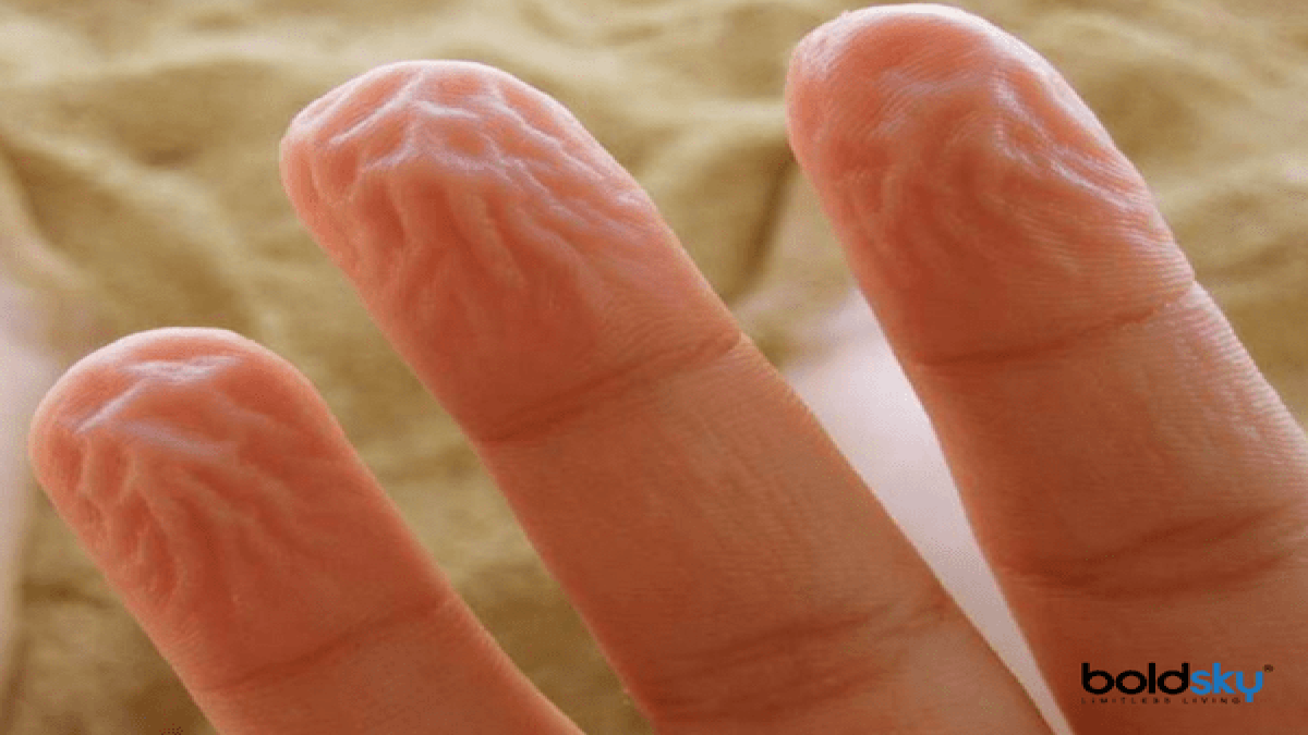 Wrinkled Or Pruney Fingers Causes, Treatment And Prevention