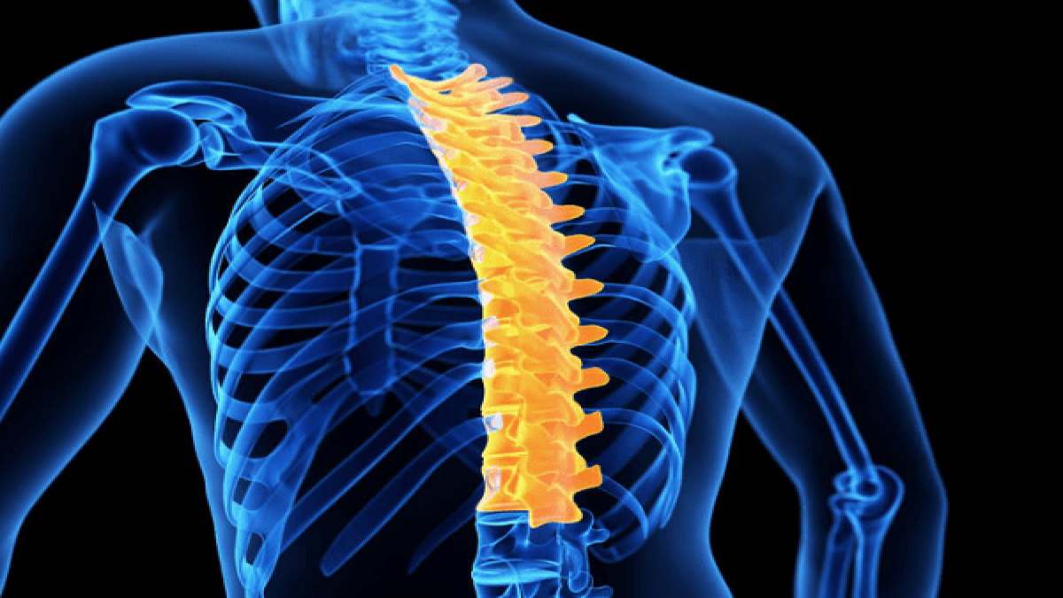 Kyphosis Causes, Symptoms, Diagnosis & Treatment