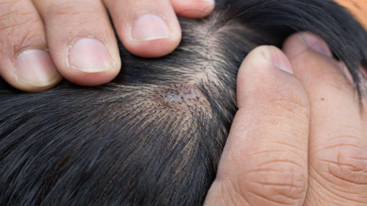 Boils On Scalp Causes, Symptoms And Treatment