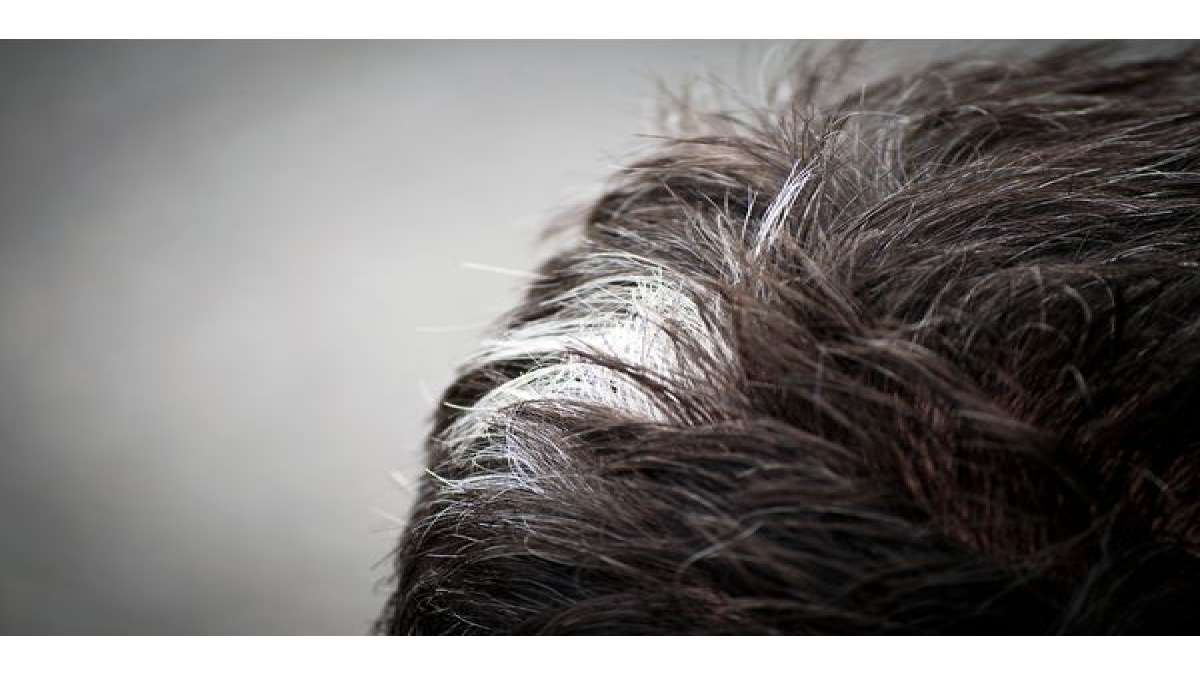 Poliosis (White Hair Patch): Symptoms, Causes And Treatment - Boldsky.com