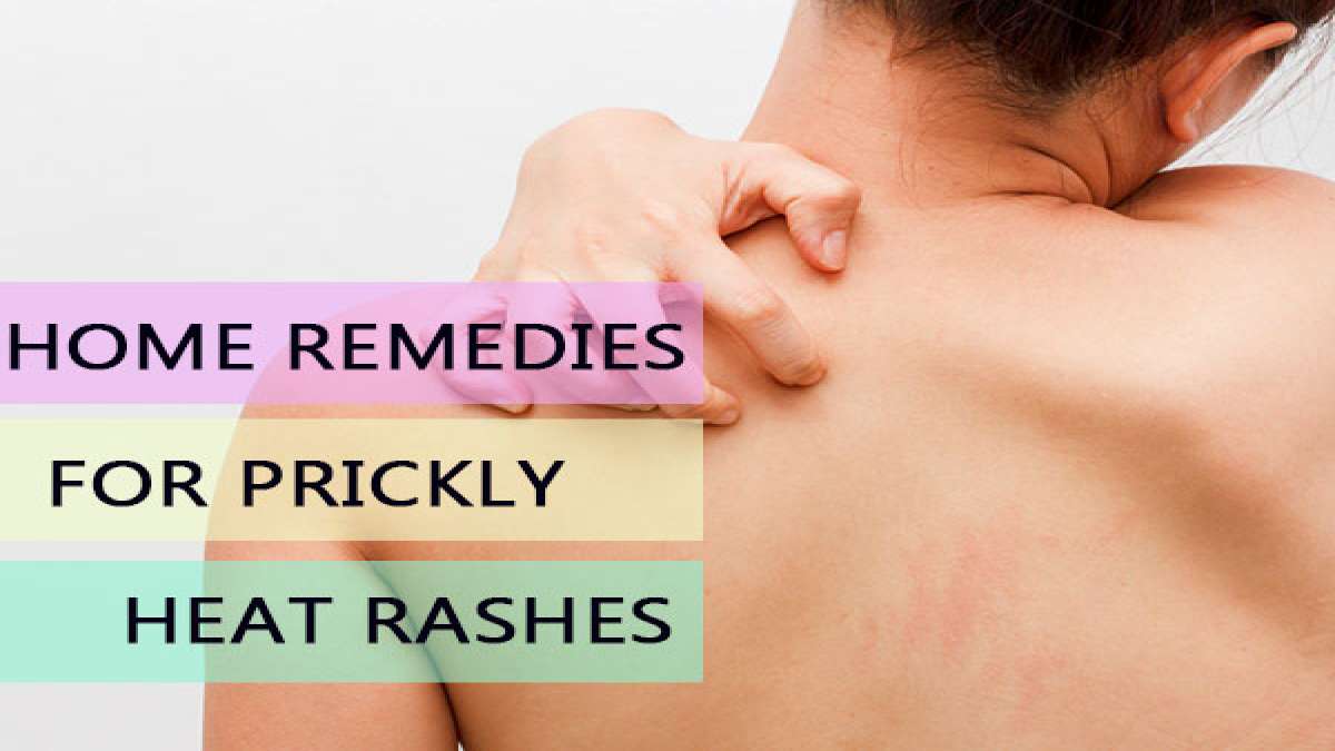 11 Effective Home Remedies For Heat Rash (Prickly Heat)