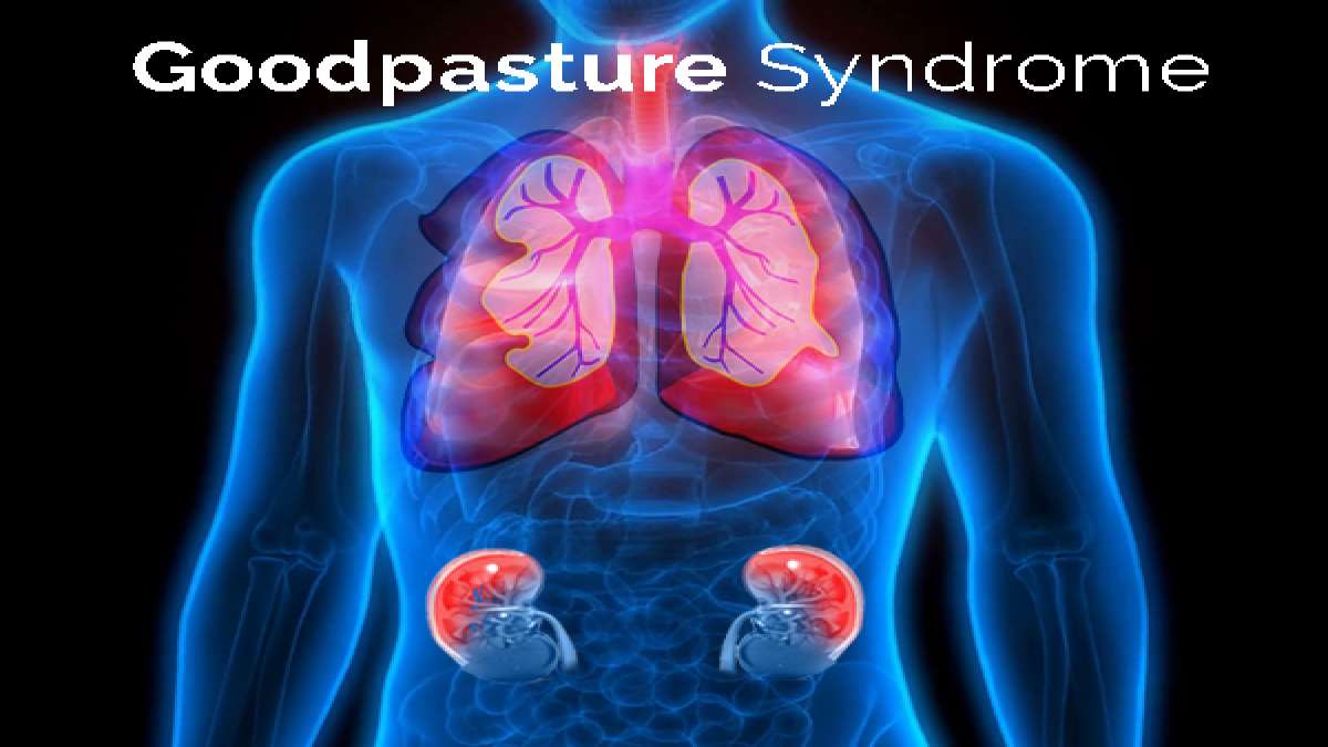 Goodpasture Syndrome (GPS) Causes, Symptoms, Diagnosis And Treatment