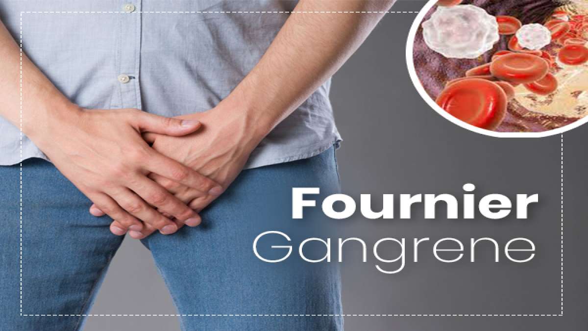 Fournier Gangrene Causes, Symptoms, Risk factors, Treatment, And Prevention