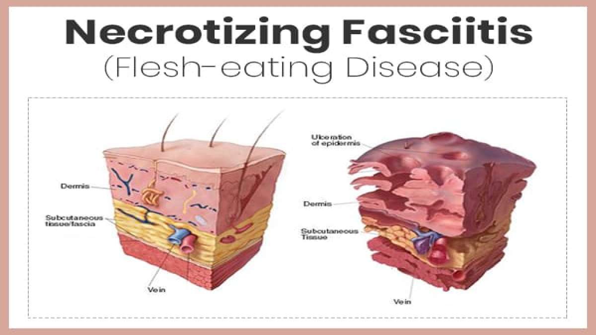 Necrotizing Fasciitis Causes, Symptoms, Diagnosis, Treatment, And