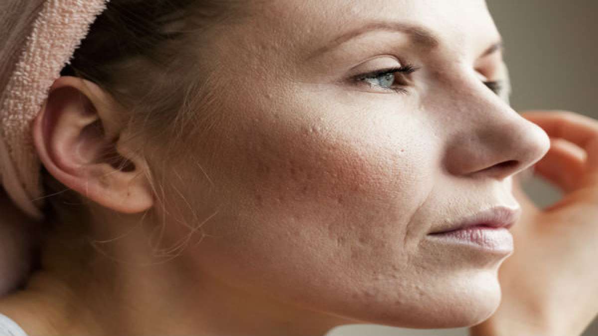 Xerosis Cutis (Dry Skin) Causes, Symptoms, Risk Factors And Treatment