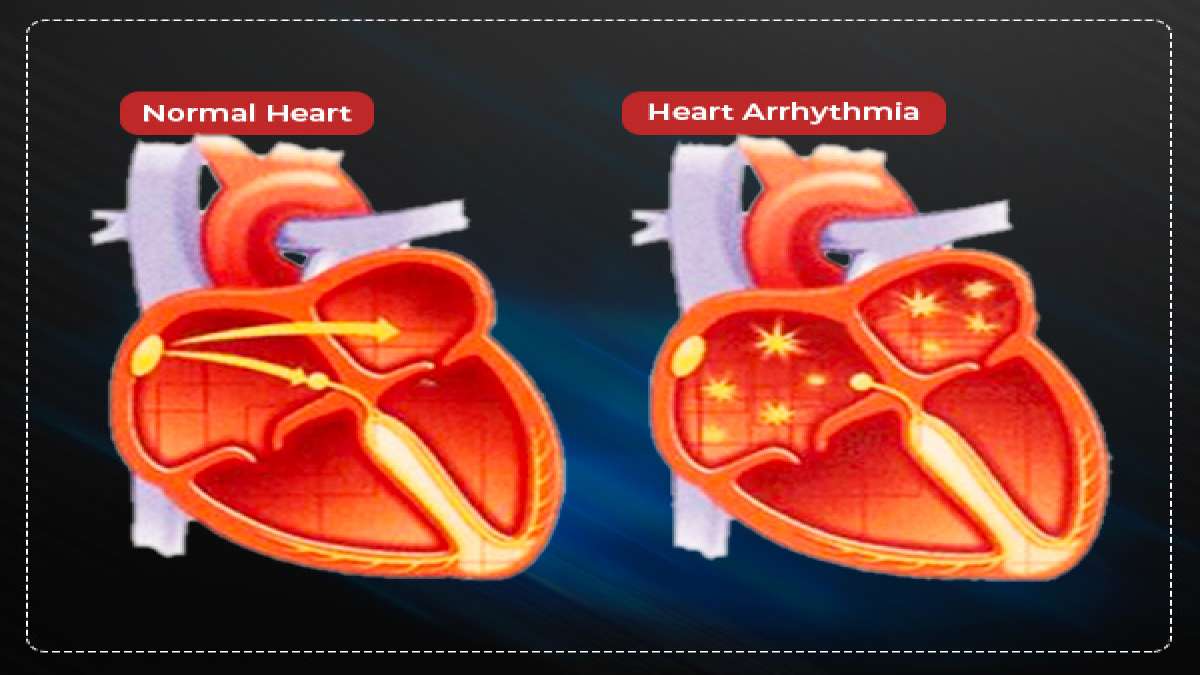 Arrhythmia Causes, Symptoms, Diagnosis And Treatment