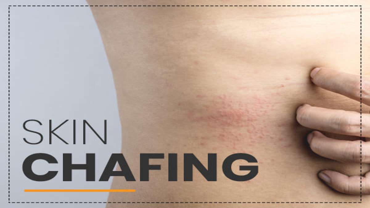 Chafing Causes, Symptoms, Complications, Treatment & Prevention