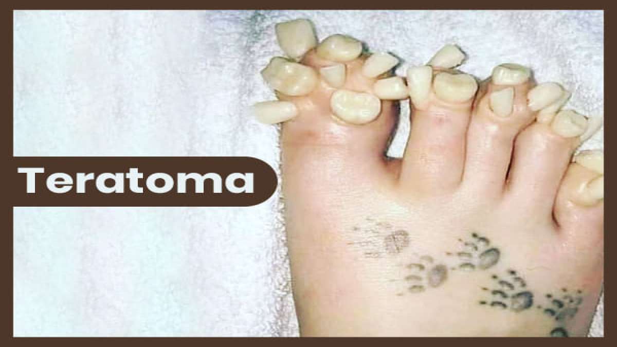Teratoma: Types, Symptoms, Causes, Diagnosis And Treatment - Boldsky.com