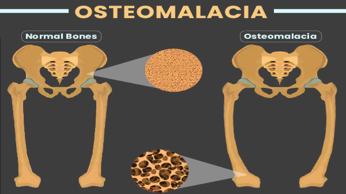 Osteomalacia Causes, Symptoms, Risk Factors, Diagnosis & Treatment