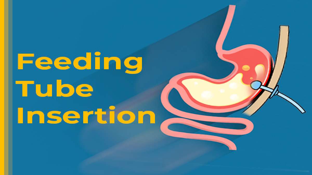 Feeding Tube Insertion (Gastrostomy) Types, Risks, Procedure And