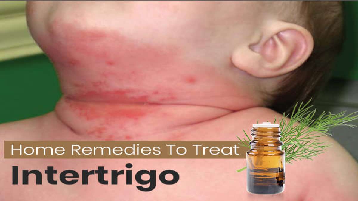 How To Treat Intertrigo Safe And Effective Home Remedies