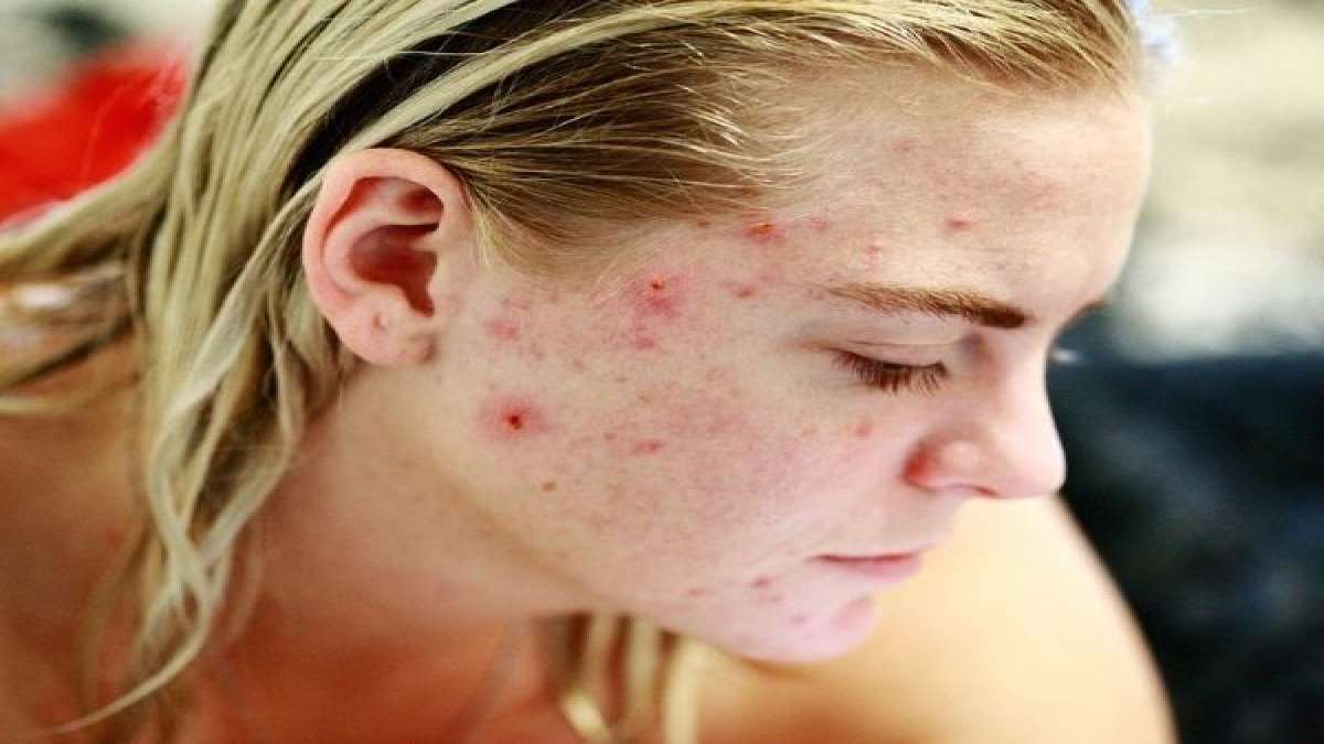How To Deal With Sudden Acne Breakout