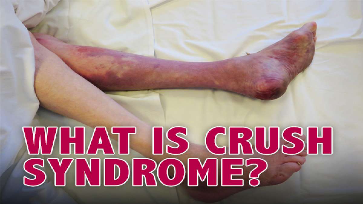 What Happens In Crush Syndrome? Know About Its Causes, Symptoms
