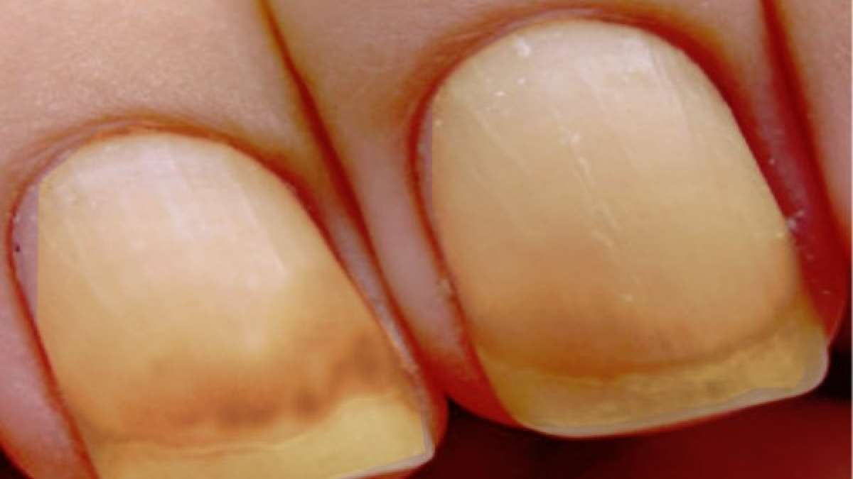 What Is Yellow Nail Syndrome? Causes, Symptoms, Complications