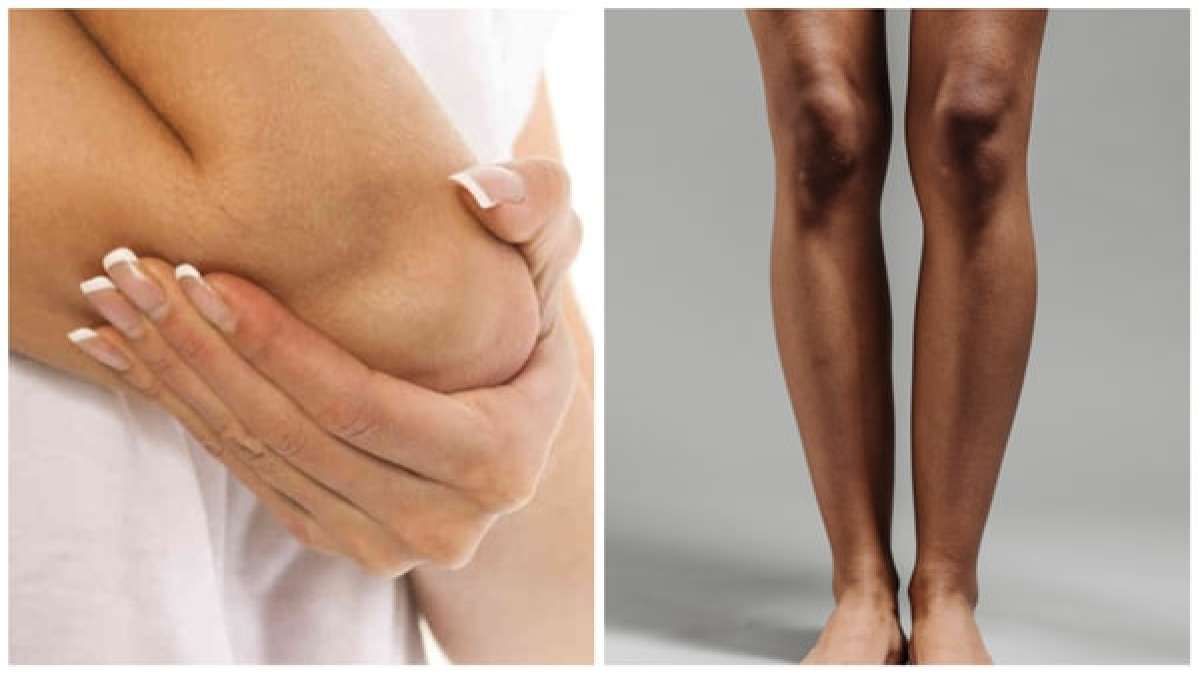 6 DIY Homemade Remedies For Dark Elbows & Knees
