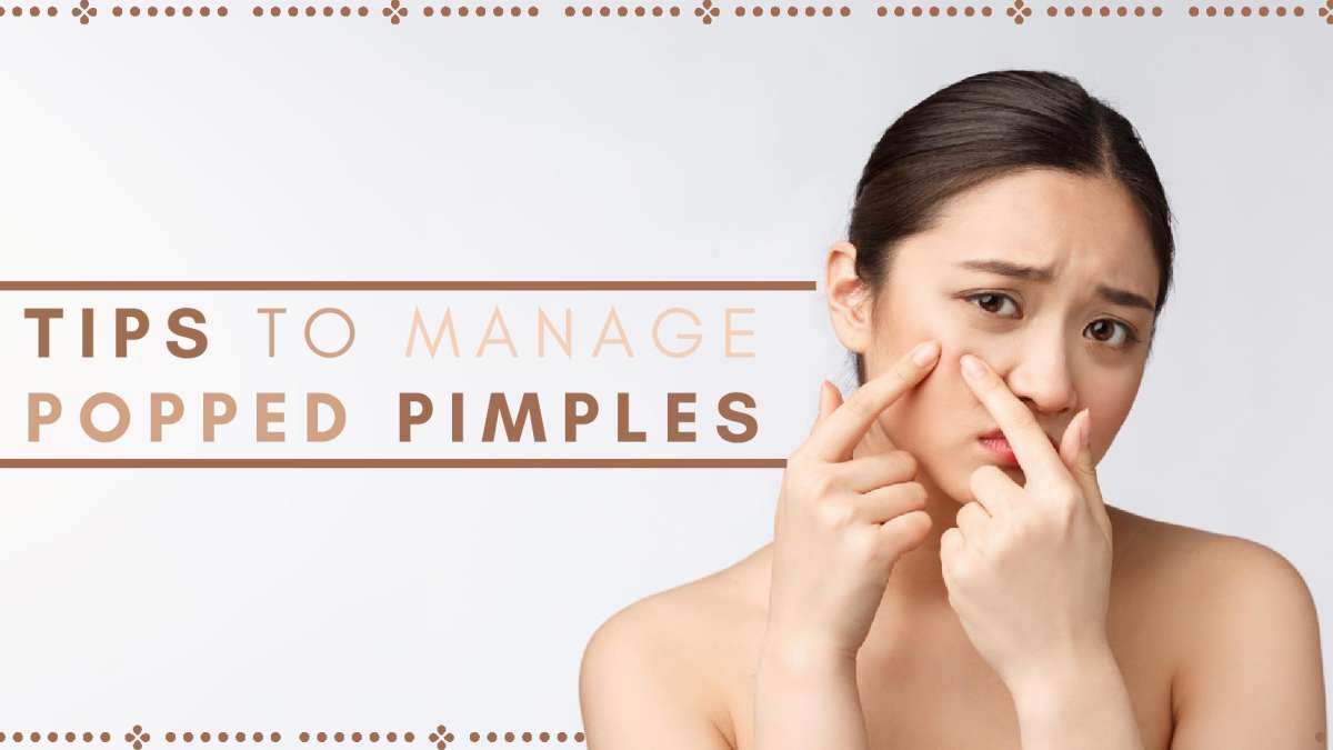 Five Tips To Manage A Popped Pimple