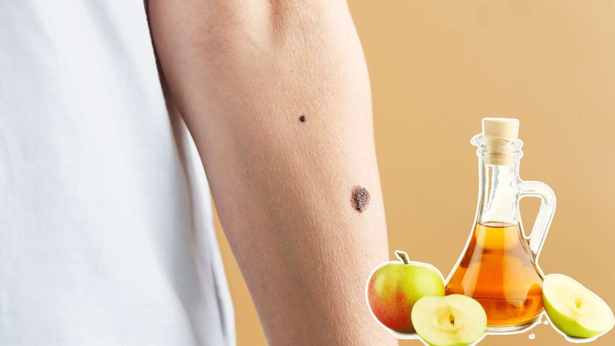 Get Rid Of Moles Fast! My Apple Cider Vinegar Recipe Is Life Changing! - 240r0gk
