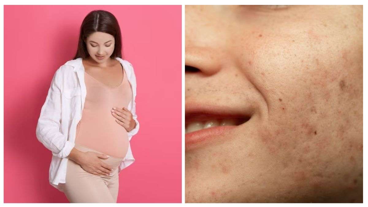 What Is Pregnancy Mask (Melasma) Ways To Manage It