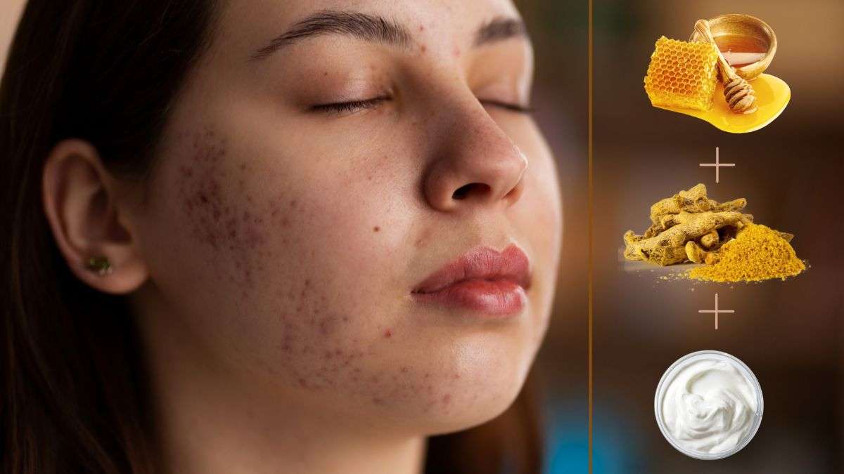 Turmeric Face Pack For Pimple Marks Try This Every Morning For 3 Weeks