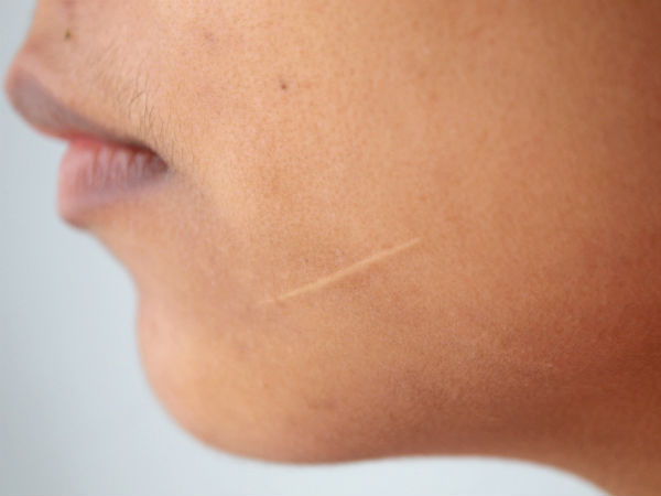 Tips To Get Rid Of Scars - Boldsky.com