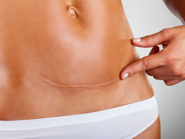 Why Women Are Depending More On C-Section?